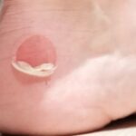 Ampoule aux pieds randonnée traitement – zoom sur pied de randonneur