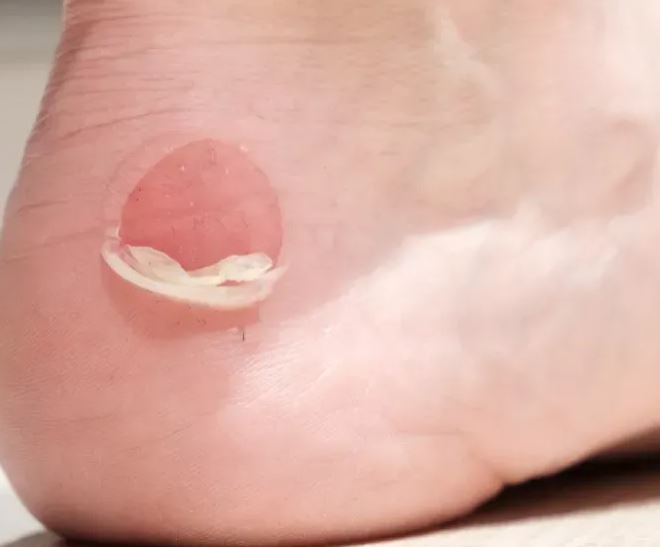 mpoule aux pieds randonnée traitement – zoom sur pied de randonneur