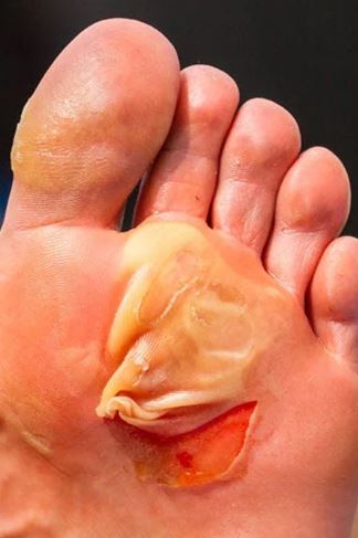 ampoule aux pieds en randonnée